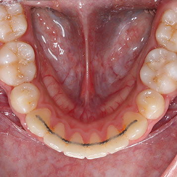 orthodontic retention